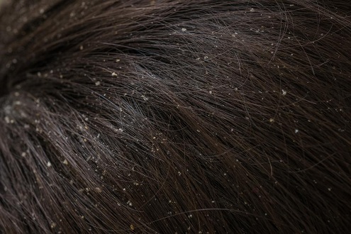 causes of dandruff 2