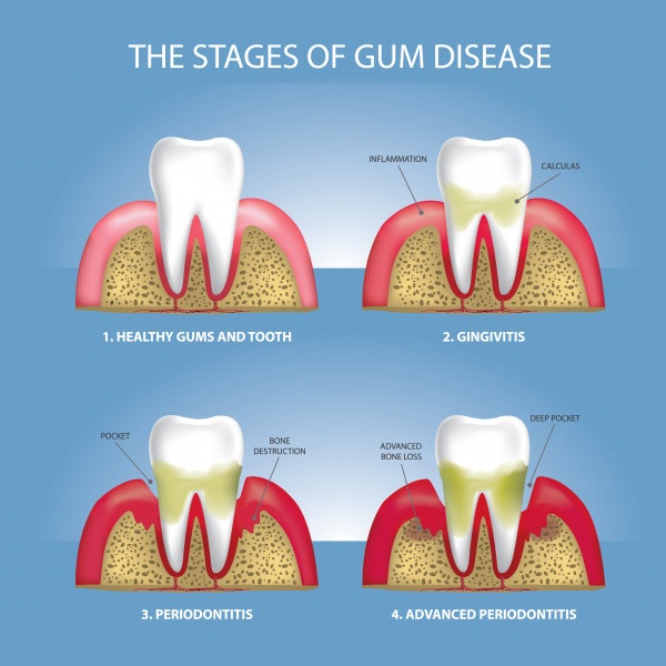 home remedies for gum diseases