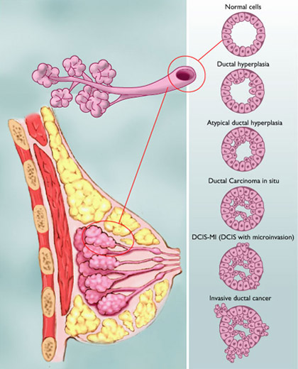 Types of breast cancer1