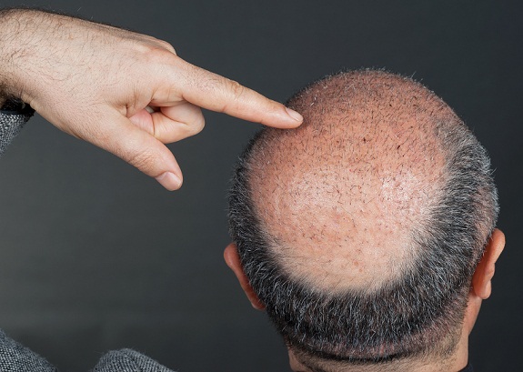 hair transplant in mumbai