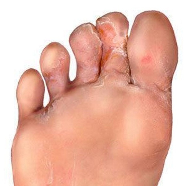 Home Remedies for Athlete's Foot