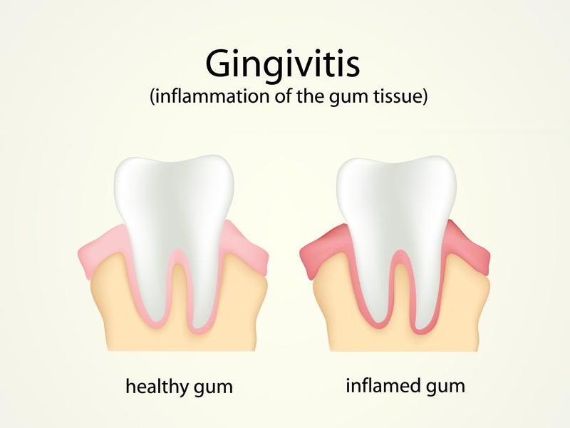 Home Remedies for Gingivitis