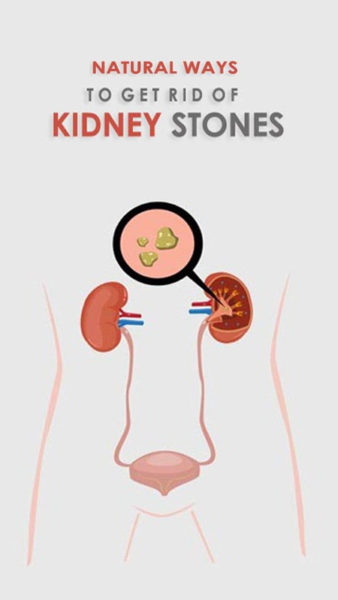 Home Remedies For Kidney Stones