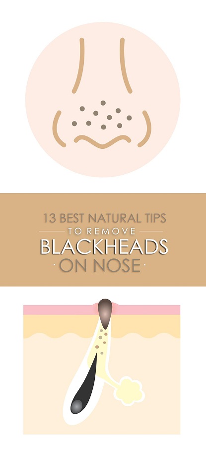 Home Remedies For Blackheads