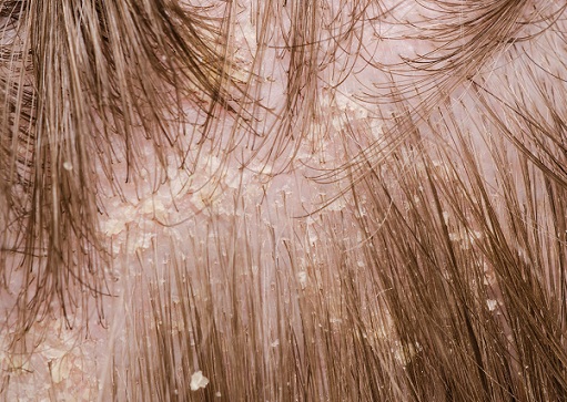 How To Get Rid Of Flakes on Scalp