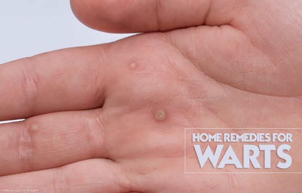 Home Remedies for skin warts