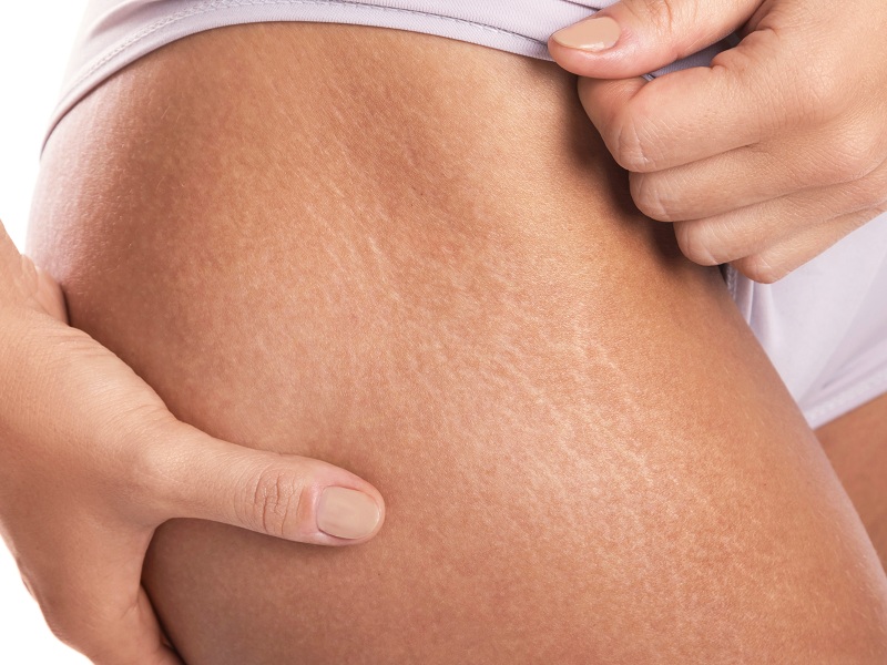 Home Remedies For Stretch Marks