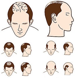 Hair Transplant In Jaipur