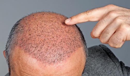 Hair Transplant Centers In Kerala