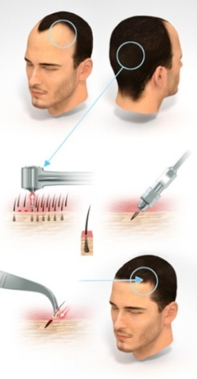 Hair Transplant Centers In Kolkata