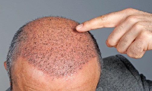 hair-transplant-kolkata