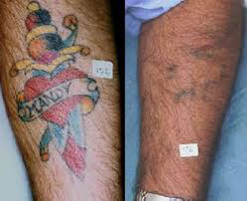 Colour Laser Tattoo Removal