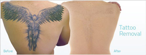 Angel Laser Tattoo Removal