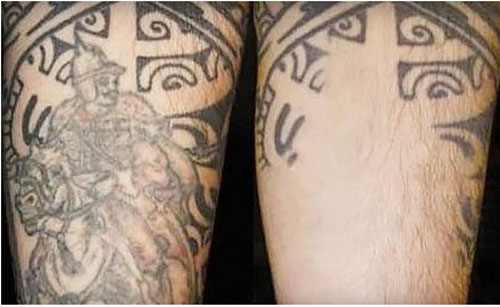 Partial Laser Tattoo Removal