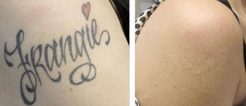 Name Tattoo Laser Removal