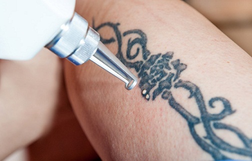 laser tattoo removal