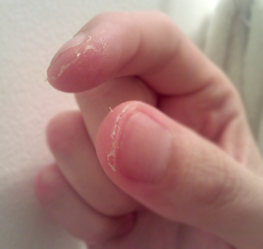 How to Get Rid of Peeling Fingertips