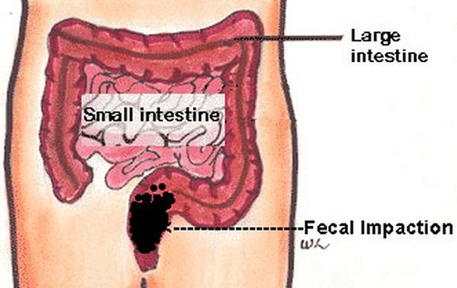 Fecal Impaction