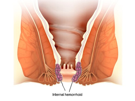 Hemorrhoids