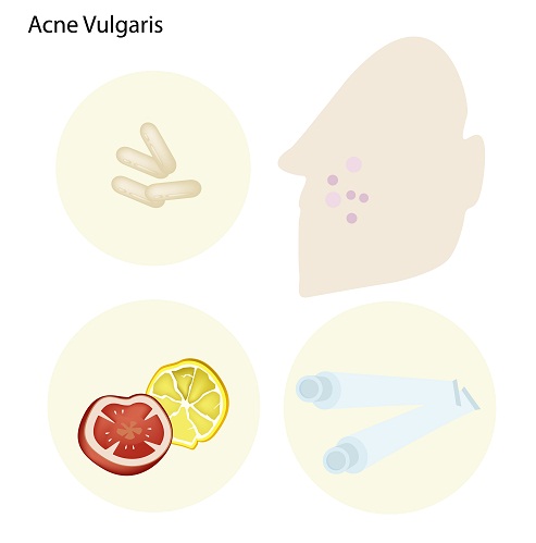 acne vulgaris