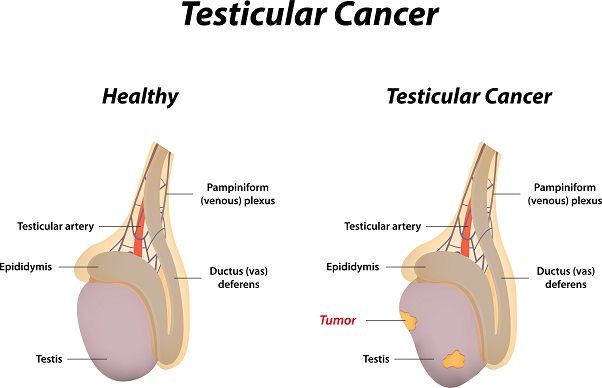 Testicular Cancer Symptoms