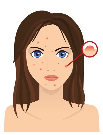 ayurvedic treatments for pimples