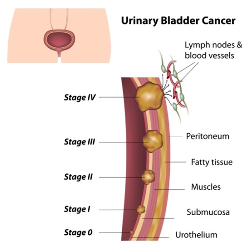 bladder cancer symptoms