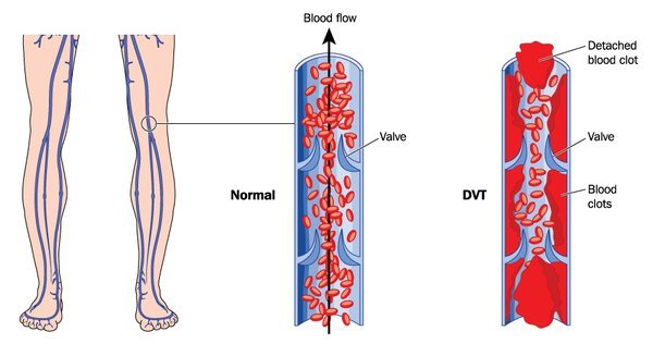 Blood Clot During Pregnancy