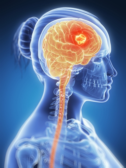 causes and symptoms of brain cancer