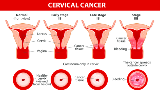 Cervical Cancer Symptoms