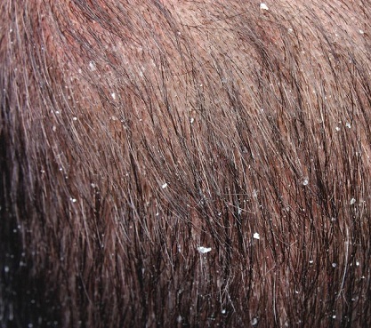 dandruff-caused-by fungal-infection