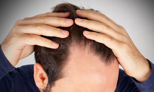 prevent-frontal-hair-loss