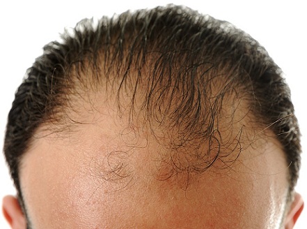 Frontal Hair Loss