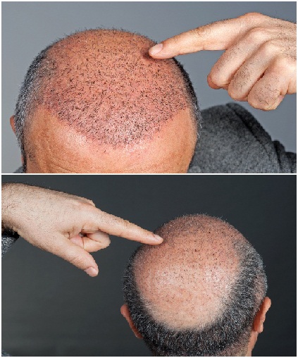 hair-transplant-side-effects