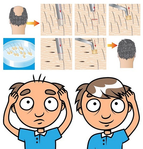 Hair Transplant Side Effects