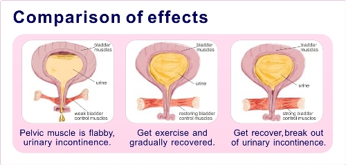 kegel exercise 1