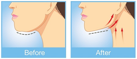 Reduce Double Chin Fast At Home