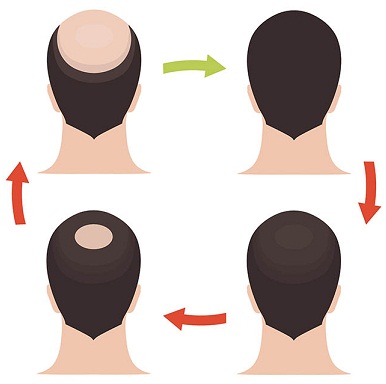 hair loss in patches