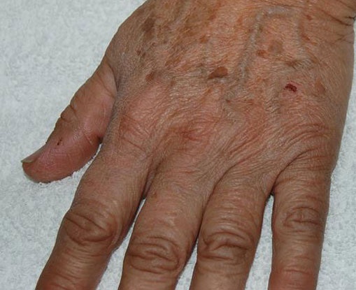 How to Get Rid of Wrinkles on Hands 6