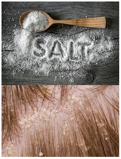 Salt for dandruff