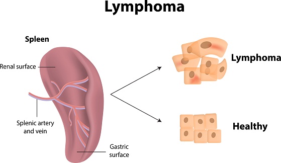 causes-and-symptoms-of-lymphoma