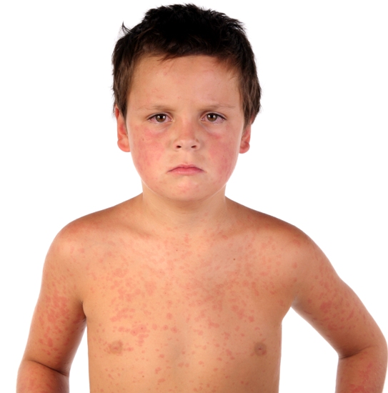 Measles (2)