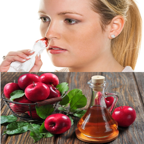 Home Remedies for Stop Nose Bleeding