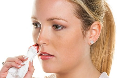 Nose Bleeding During Pregnancy Causes and Remedies