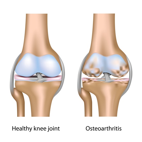 causes-and-symptoms-of-osteoporosis