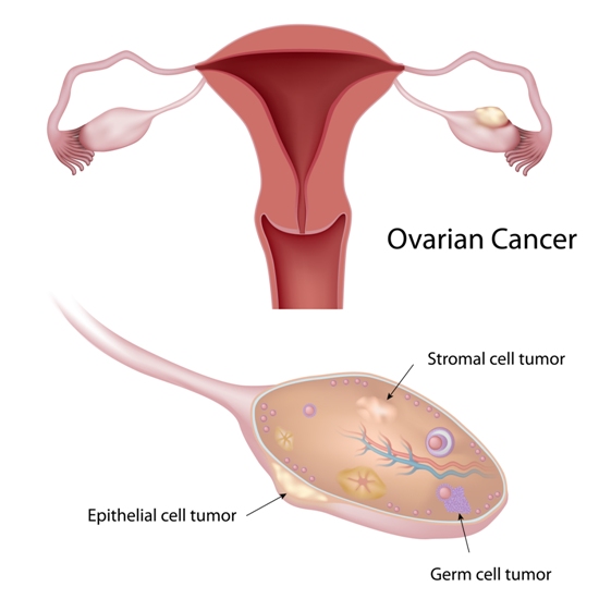 Ovarian cancer