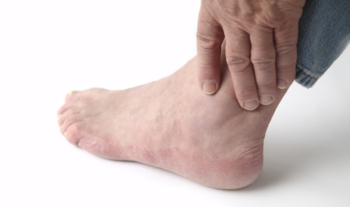 home remedies for gout