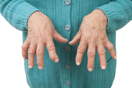 Rheumatoid Arthritis Symptoms