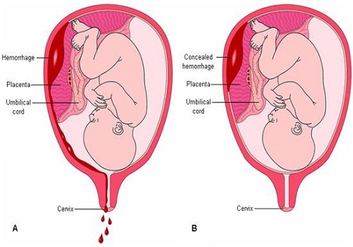 Spotting During Pregnancy 6