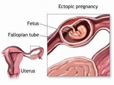 Spotting During Pregnancy 7